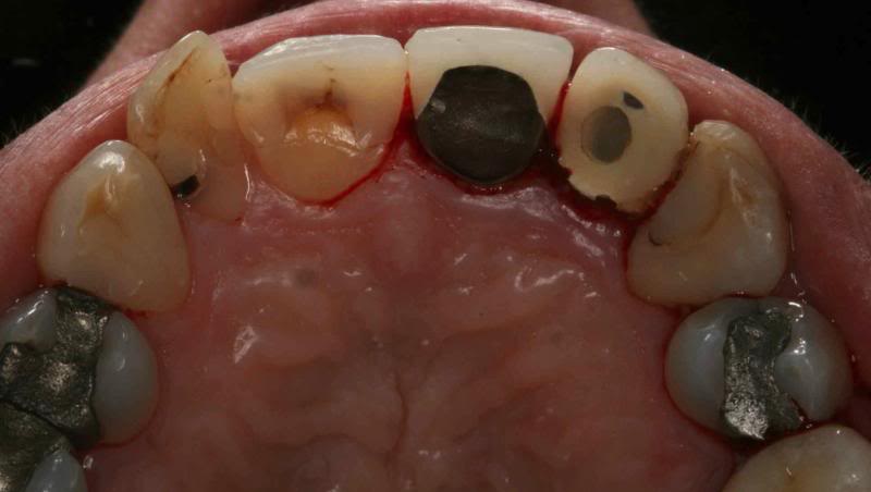 case 1 bottom teeth before