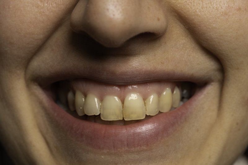Closeup of stained teeth