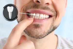 Nose-to-chin closeup of man pulling down his lip to reveal a dental implant (indicated via diagram)