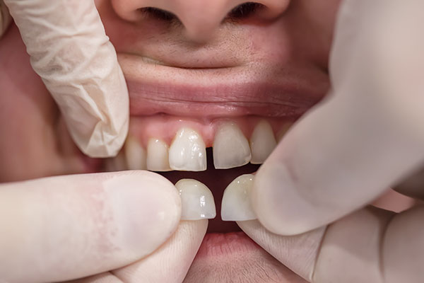 dentist attaching veneers to patient's teeth